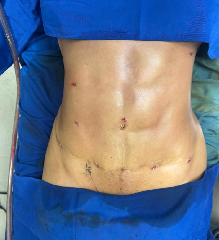 Liposuction Case